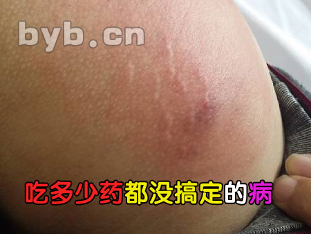 byb.cn 吃多少藥都沒搞定的病